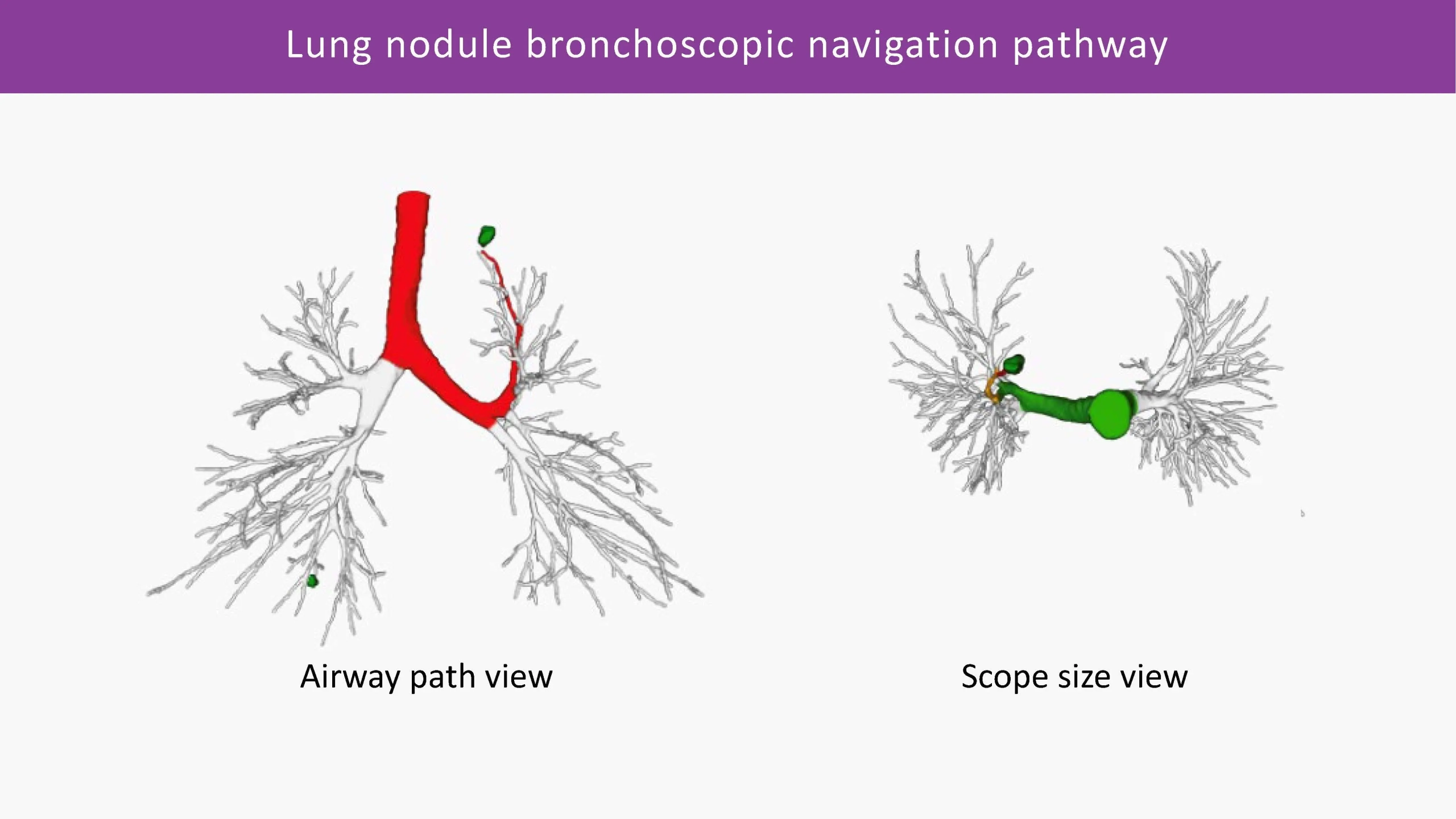 Lung nodule bronchoscopic navigation pathway