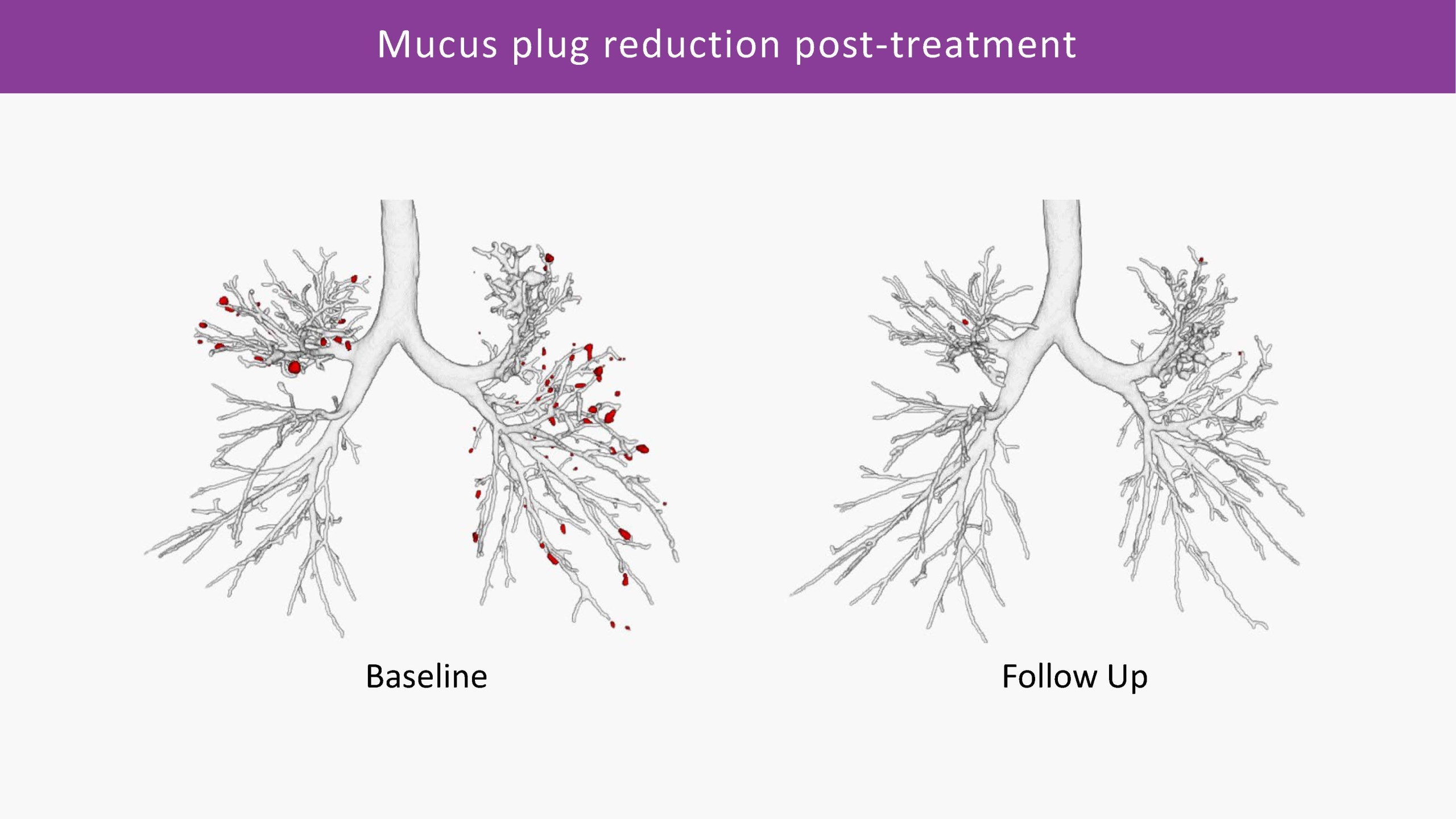 Mucus plug reduction treatment