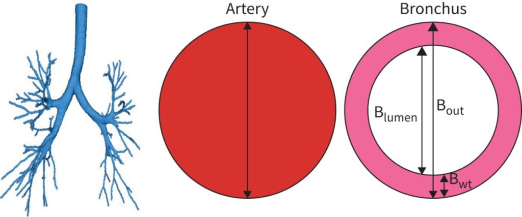 LungQ-BA software segments the bronchial tree, identifies the generation for each bronchus–artery (BA) pair and measures the following BA dimensions: outer bronchial wall diameter (Bout), adjacent artery diameter (A) and bronchial wall thickness (Bwt).
