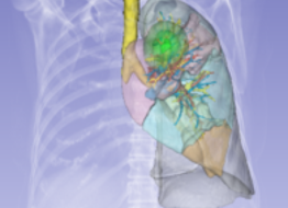 3D lung model with lobes segmented in different colors, the tumor highlighted in green, and the planned resection margins shown as surrounding zones